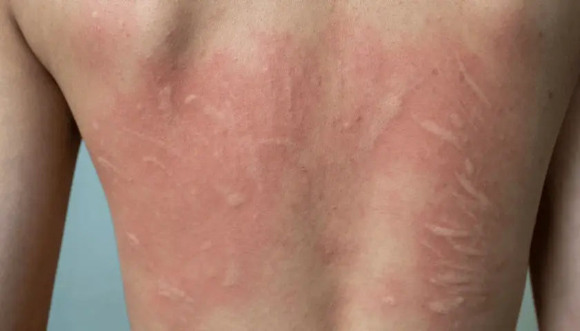 Schiena di un bambino con eritema e pomfi, segni tipici di orticaria. Come riconoscerla nei più piccoli.