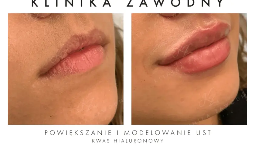 Kwas hialuronowy na usta: Nawilżenie czy powiększanie? Poznaj prawdę