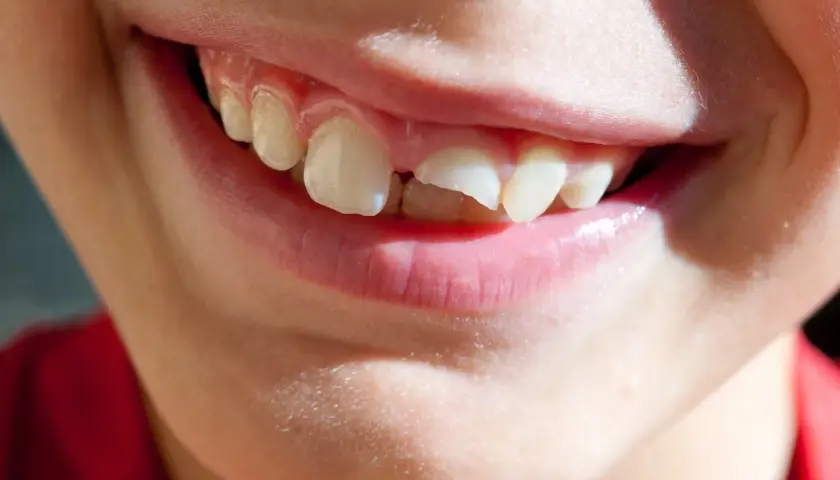 Sorriso di bambino con un dente spezzato, un piccolo incidente che non ferma la gioia.