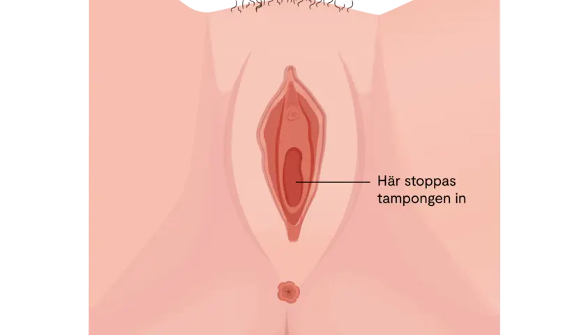 Illustration av underlivet som visar en eventuell obalans i underlivet efter samlag. Texten indikerar var tampongen förs in.