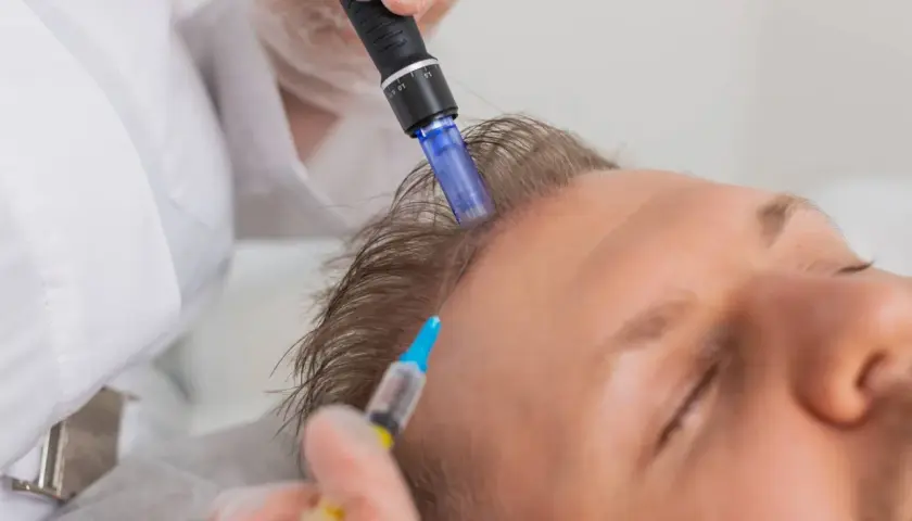 Un profesional realiza microneedling capilar en la cabeza de un hombre, aplicando un tratamiento para estimular el crecimiento del cabello.