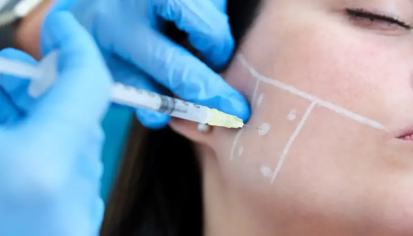 En injektion ges i käkpartiet, markerat med linjer, för masseter botox.