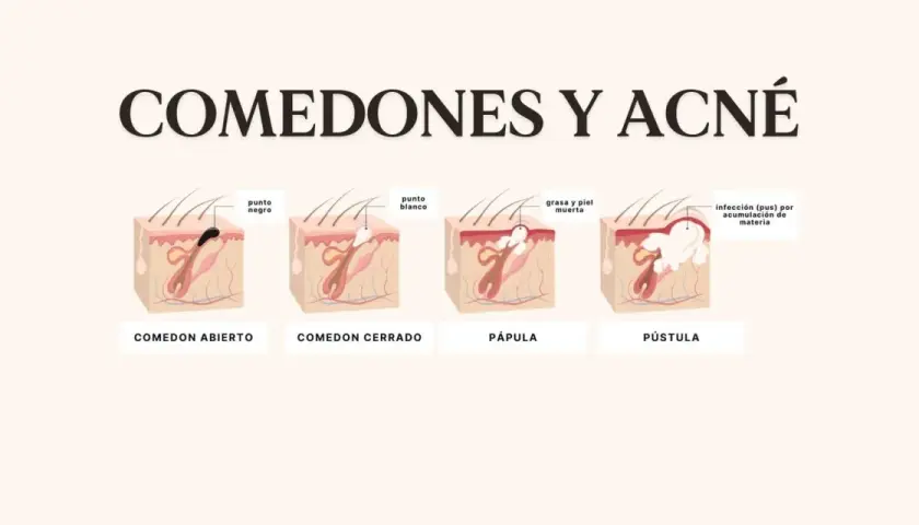 Ilustración de la piel mostrando un punto negro enquistado, un punto blanco, pápula y pústula, explicando el acné.