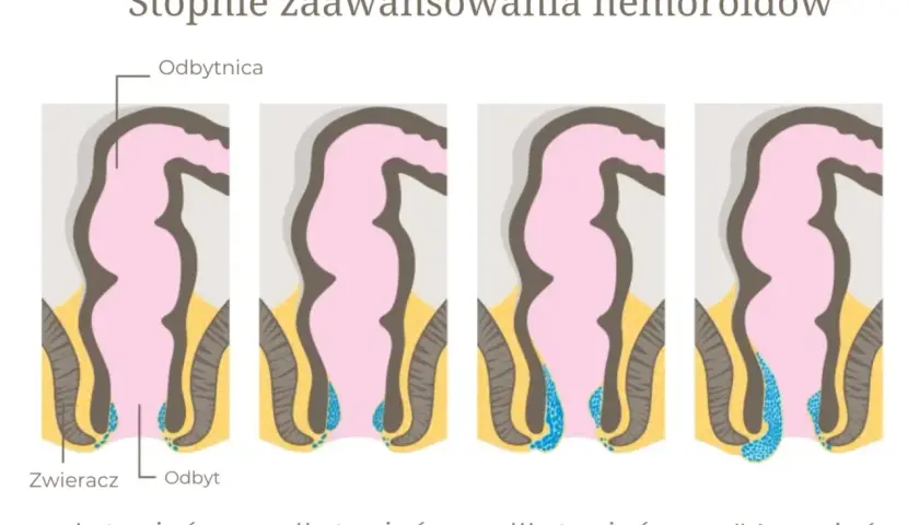 Ilustracja przedstawia cztery stopnie zaawansowania żylaków odbytu, od I do IV, pokazując ich stopniowe powiększanie się.