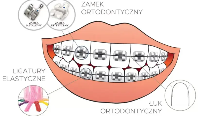 Jak działa aparat na zęby? Odkryj sekrety prostego uśmiechu!