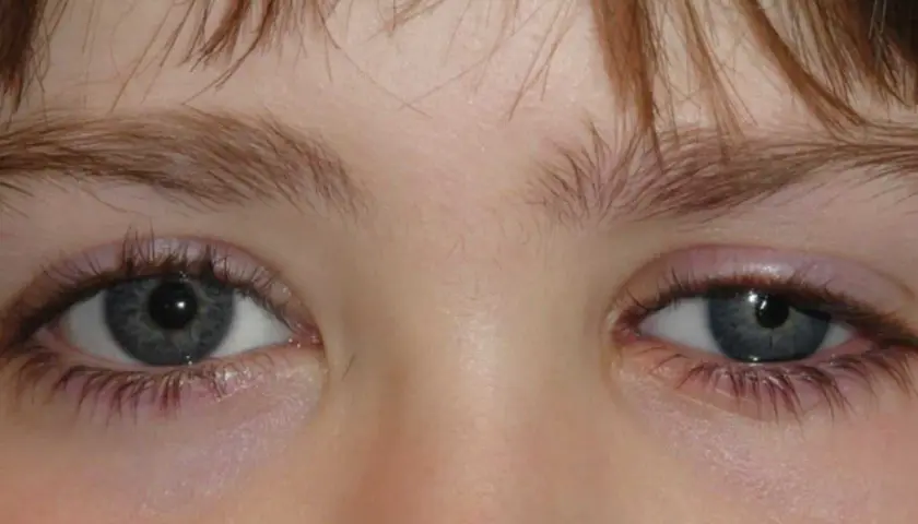 Ojos hundidos de un niño, con pestañas largas y cejas finas.