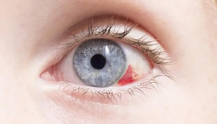 Ojo azul con hemorragia subconjuntival. Parece un bebé con ojos rojos por fuera, pero es un adulto.