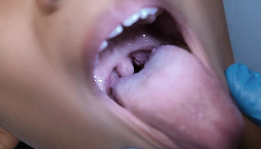 Vista ravvicinata della bocca aperta, con la lingua che mostra un rigonfiamento e arrossamento, indicativo di un ascesso palato.