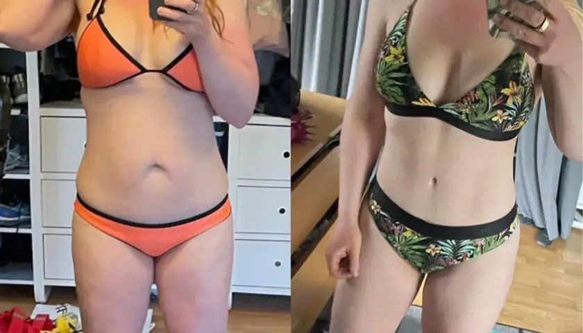 Före och efterbilder visar en kvinnas mage före och efter en full bukplastik.