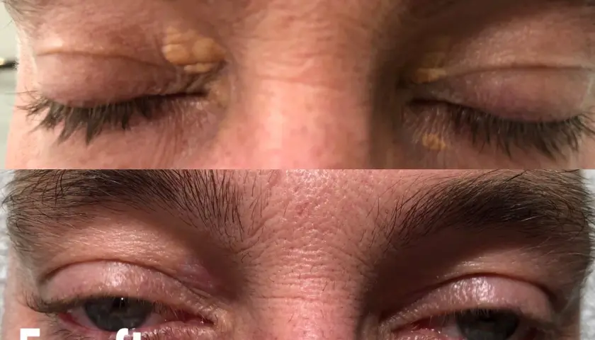 Före- och efterbilder som visar hur xantelasma har behandlats.