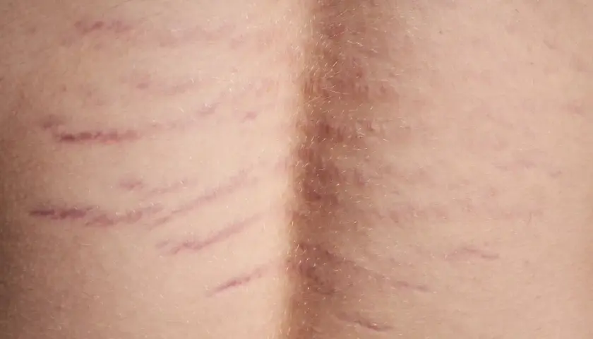 Widoczne rozstępy na plecach, świadectwo zmian w skórze, tworzą delikatny wzór na jasnej karnacji.