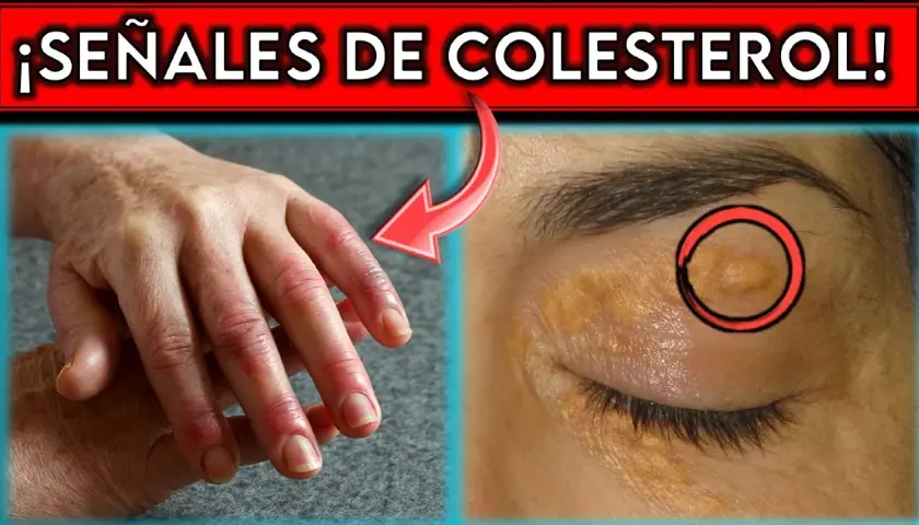 Síntomas de colesterol alto: ¿estás ignorando señales preocupantes?
