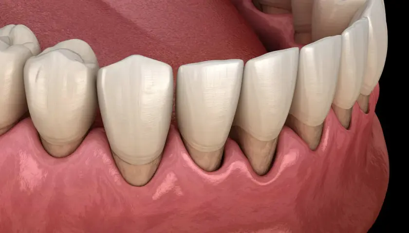 Dientes sanos y encías rosadas. Ilustración que muestra cómo tratar periodontitis para recuperar la salud bucal.