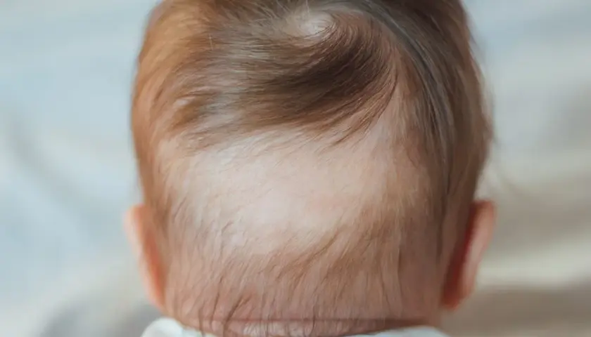 Dettaglio della nuca di un neonato con capelli castani e una chiazza di piebaldismo, dove i capelli sono più chiari.