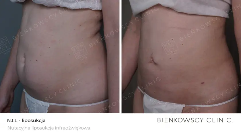 Liposukcja: Co to? Metody, efekty, rekonwalescencja. Czy to dla Ciebie?