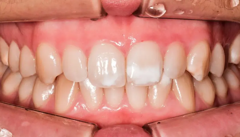 Denti con macchie bianche, possibili segni di carie iniziale.