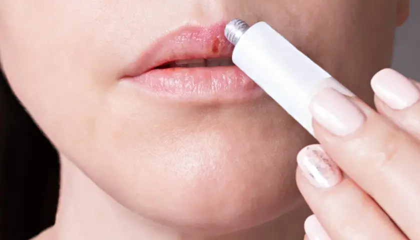 Persona aplica crema en un labio con un afta labial.
