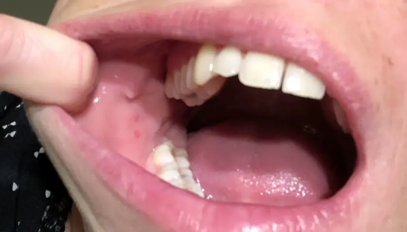 Dettaglio della bocca con afte sulla guancia interna. Si notano piccole lesioni rosse e gonfiore.