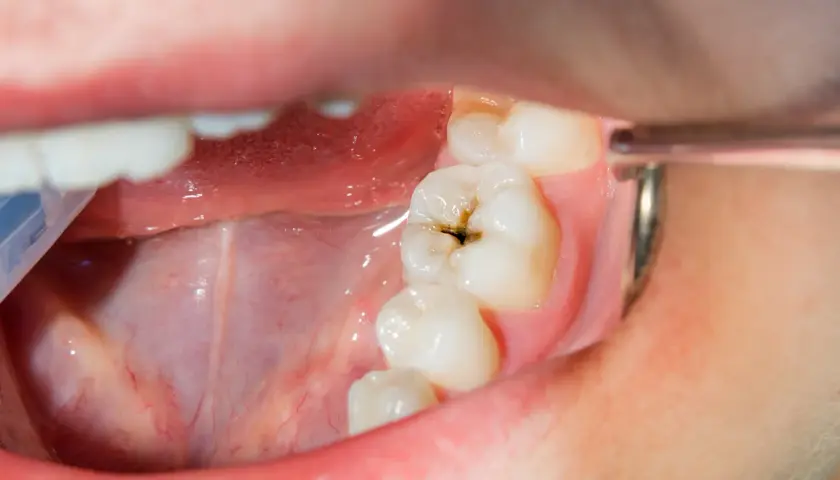 Vista de cerca de una boca con un diente que muestra caries debajo de la encía.