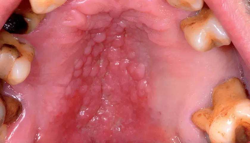 Dettaglio dell'interno bocca con palato arrossato e noduli, circondato da denti.