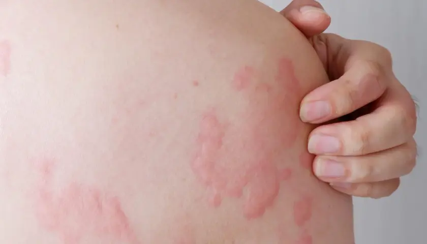 Pelle con pomfi rossi e pruriginosi, tipici dell'orticaria. Potrebbe essere un caso di orticaria bambini, che richiede attenzione.
