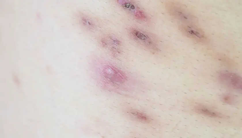 Widoczne liczne zmiany skórne, w tym ropne krosty i blizny. Na plecach pojawił się czarny wągier, który wymaga uwagi.