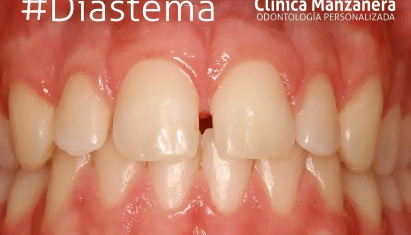 Primeros planos de dientes con un espacio visible entre los incisivos centrales superiores, un ejemplo de brackets dientes separados.
