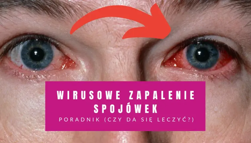 Czerwone, podrażnione oczy z widocznymi naczynkami. Napis: "Wirusowe zapalenie spojówek - poradnik".
