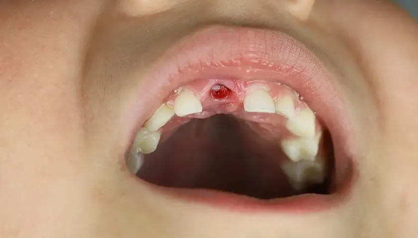 Boca de niño con un hueco donde antes había un diente, como si fuera un sueño que se te cae una muela.