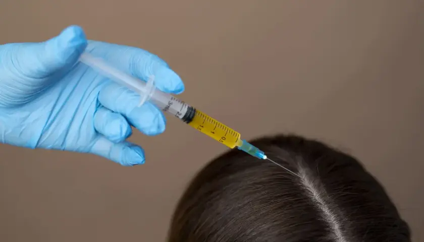 Manos enguantadas aplican inyección de ácido hialurónico en el cuero cabelludo para el cuidado del pelo.