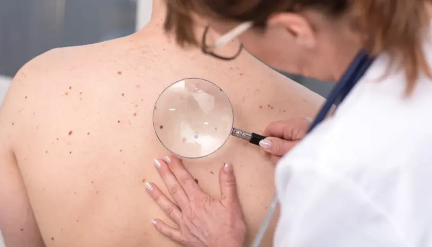Dermatolog bada liczne znamiona na plecach pacjenta za pomocą lupy.
