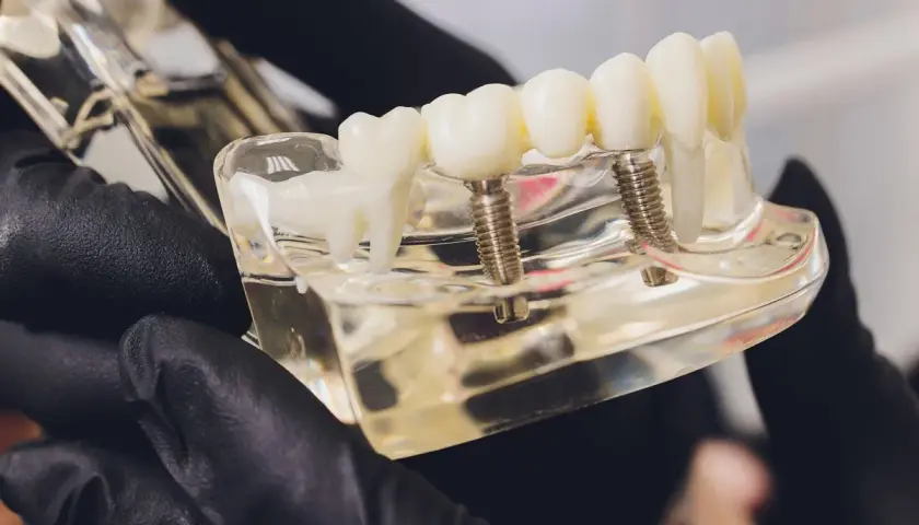 Modello di protesi dentale che illustra l'impianto dentale all on four, con viti che simulano gli impianti.