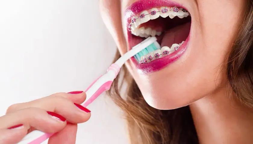 Mujer cepillando sus brackets transparentes con un cepillo rosa y blanco.