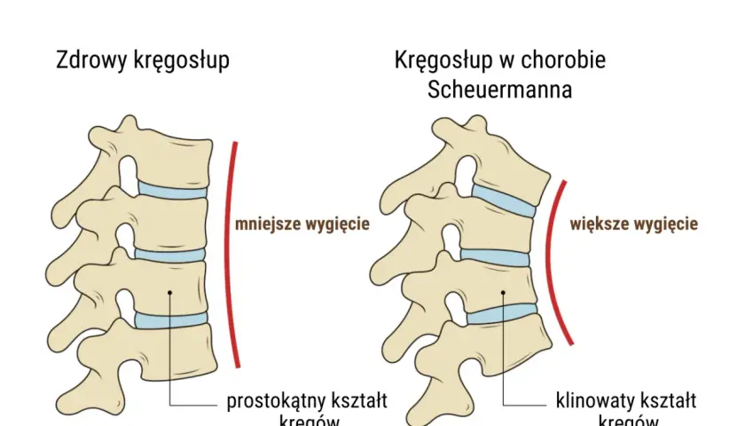 Porównanie kręgosłupa zdrowego i w chorobie Scheuermanna u dorosłych. Widoczne klinowate kręgi i większe wygięcie kręgosłupa.