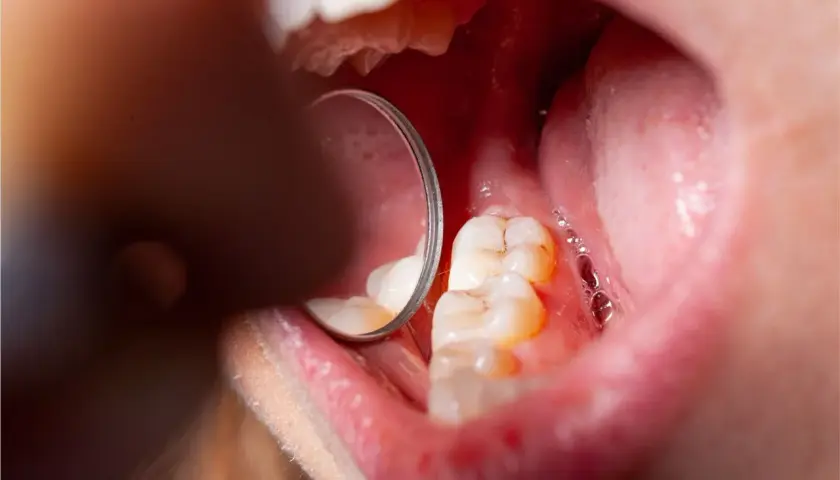 Widok jamy ustnej z widocznymi zębami i lustrem dentystycznym. Na zębach widoczne są oznaki demineralizacji szkliwa, co może prowadzić do próchnicy.