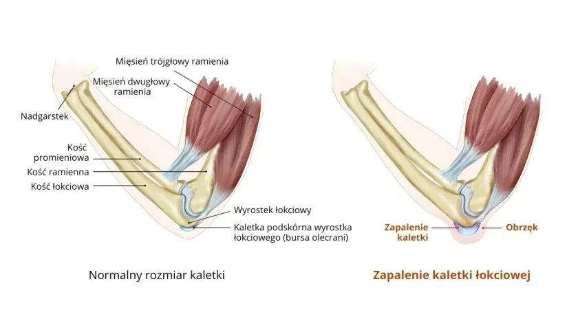 Ilustracja porównuje zdrowy łokieć z zapaleniem kaletki łokciowej. Widać obrzęk i płyn w łokciu po prawej stronie.