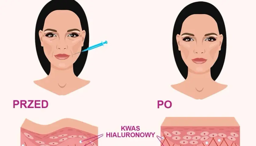 Doustny kwas hialuronowy: fakty o skórze i stawach. Czy działa?