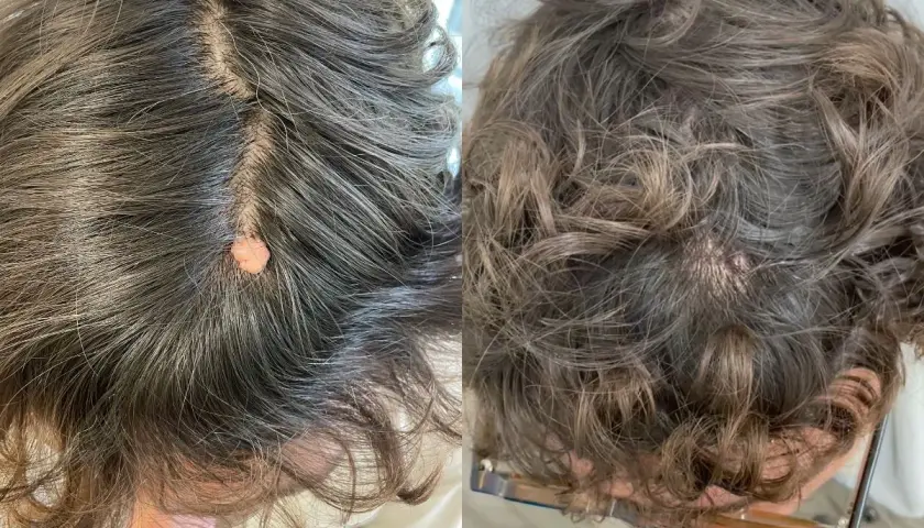 Comparación de verrugas en la cabeza antes y después del tratamiento.
