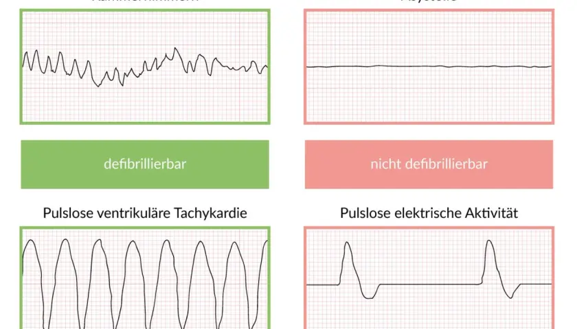 EKG-Kurven: Kammerflimmern & pulslose ventrikuläre Tachykardie (defibrillierbar) vs. Asystolie & pulslose elektrische Aktivität (nicht defibrillierbar). Wichtig für Lebenserwartung nach Reanimation.