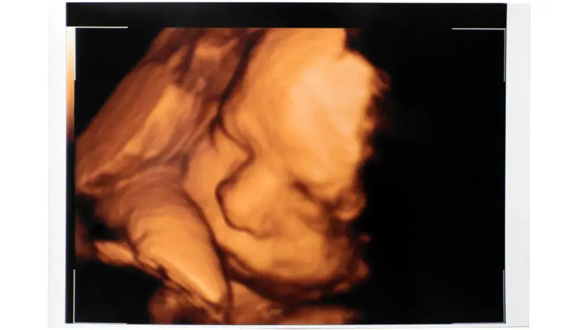 Ecografia 3D di un feto. Il profilo del bambino è ben visibile, con la bocca e il naso definiti. Dopo la morfologica si può stare tranquilli.