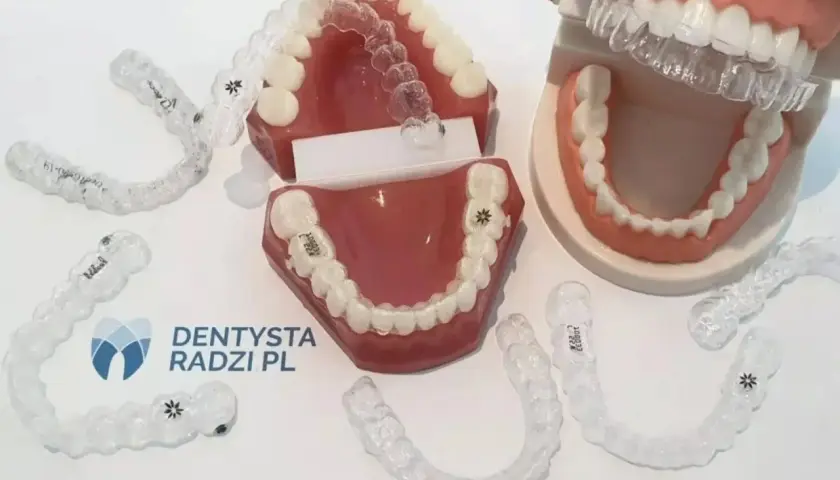 Modele szczęk z aparatami ortodontycznymi. Rozwiązanie dla dorosłych z krzywymi zębami.
