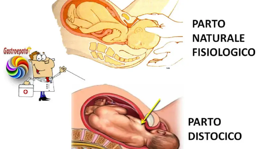 Illustrazione di un parto naturale fisiologico e di un parto distocico, dove il bambino è in posizione anomala.