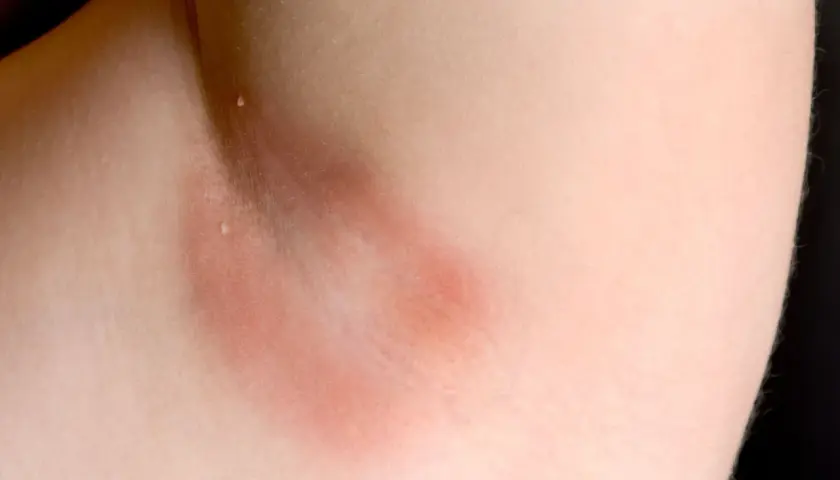 Czerwone plamy pod pachami, zaczerwienienie skóry w okolicy pachy, możliwe podrażnienie.