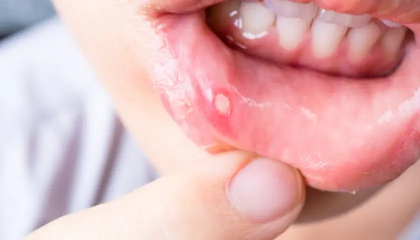 L'immagine mostra una vescicola dolorosa sulla mucosa labiale, tipica della stomatite erpetica. Quanto dura? Solitamente una settimana.