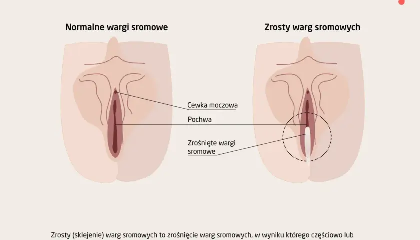 Ilustracja pokazuje, jak wygląda cipa: normalne wargi sromowe i zrośnięte wargi sromowe, z zaznaczoną cewką moczową i pochwą.