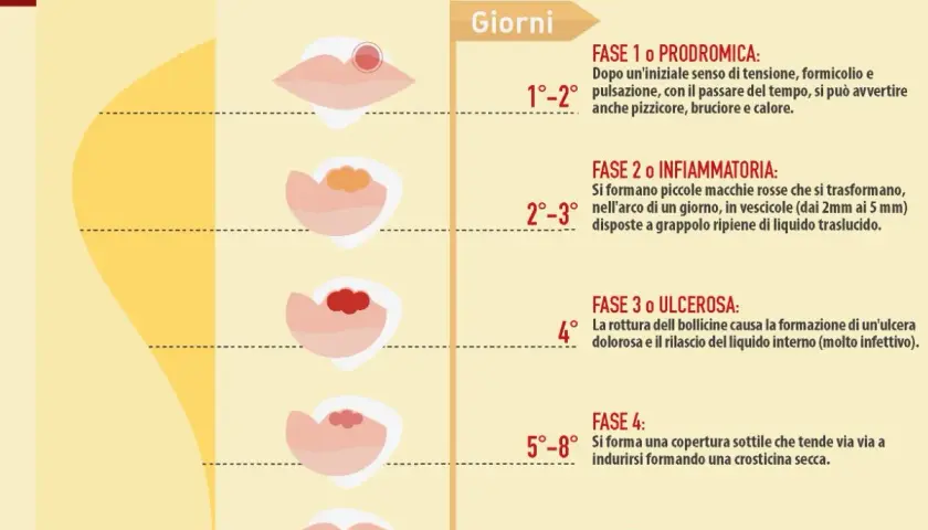 Le fasi dell'herpes labiale: dalla fase prodromica (1-2 giorni) con pizzicore, alla formazione di vescicole (2-3 giorni), ulcere (4° giorno), crosticine (5-8 giorni) fino alla guarigione (9-12 giorni). Le cause del herpes labiale frequente sono legate ...
