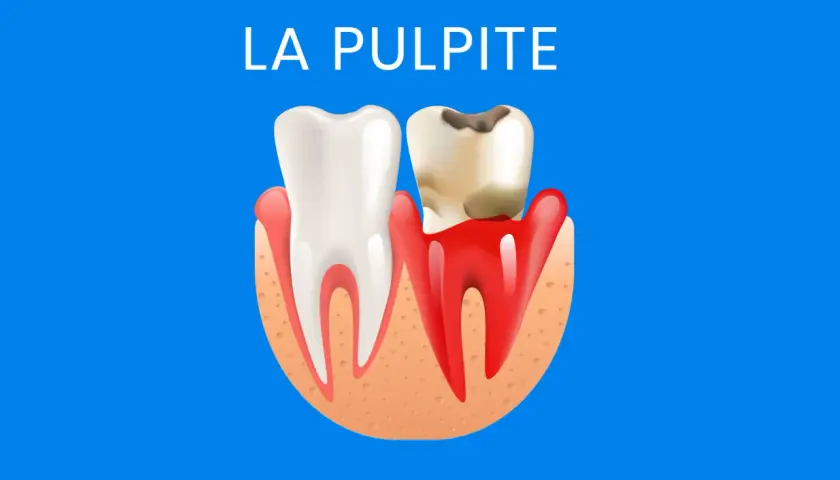 Dente sano e dente cariato con gengive infiammate. Illustrazione sulla pulpite, suggerendo la necessità di rimedi per il nervo dente infiammato.