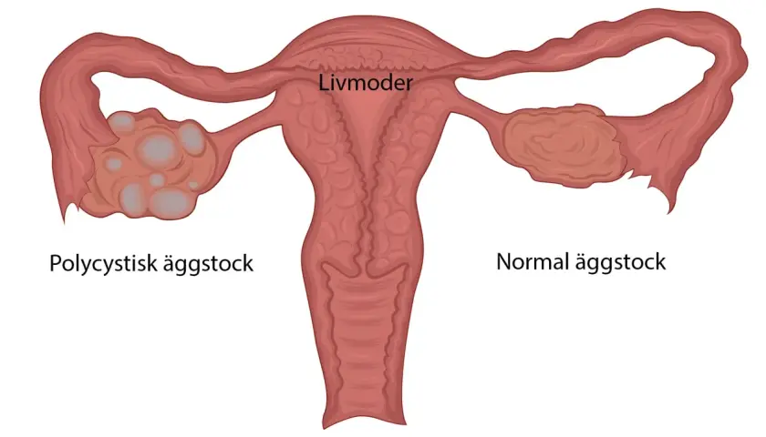 Illustration av livmoder med en normal äggstock och en polycystisk äggstock, en vanlig pcos symptom.