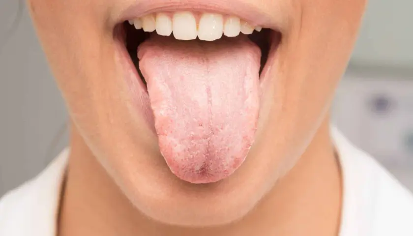 Boca abierta mostrando lengua rosada y blanca, con posible acidez en la boca y lengua.