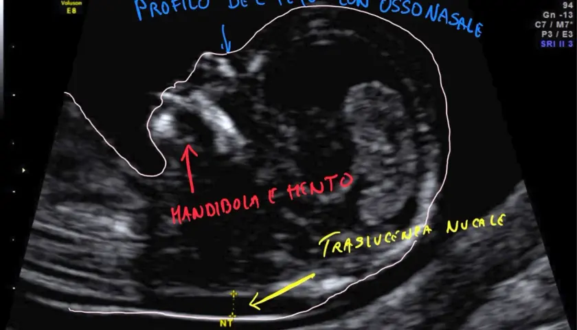 Profilo fetale con osso nasale, mandibola e mento visibili. Misurazione traslucenza nucale (NT) per bi test.